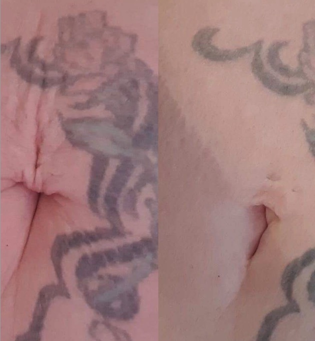 Fibro 1
