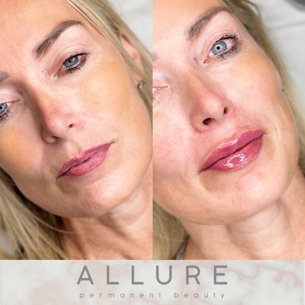 Lip filler min